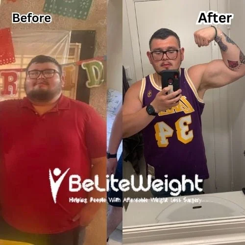 Weight Loss Surgery Gastric Sleeve before and after